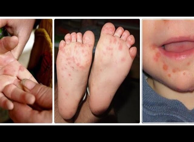 "الصحة تكشف تفاصيل بروتوكول علاج مرض HFMD وإرشادات الوقاية" 1 5 1